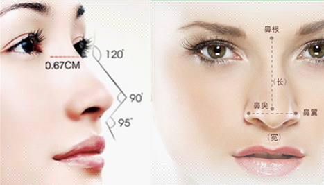 艺星综合隆鼻效果